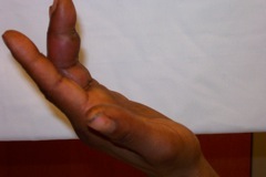 Flexor Tenosynovitis